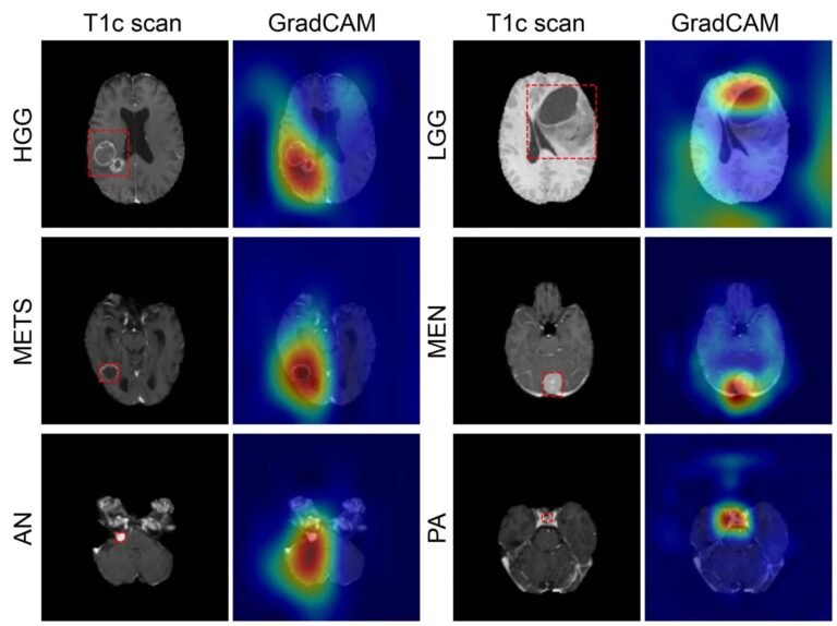 AI Model Quickly Identifies Residual Brain Tumors During Surgery AI Model Quickly Identifies Residual Brain Tumors During Surgery