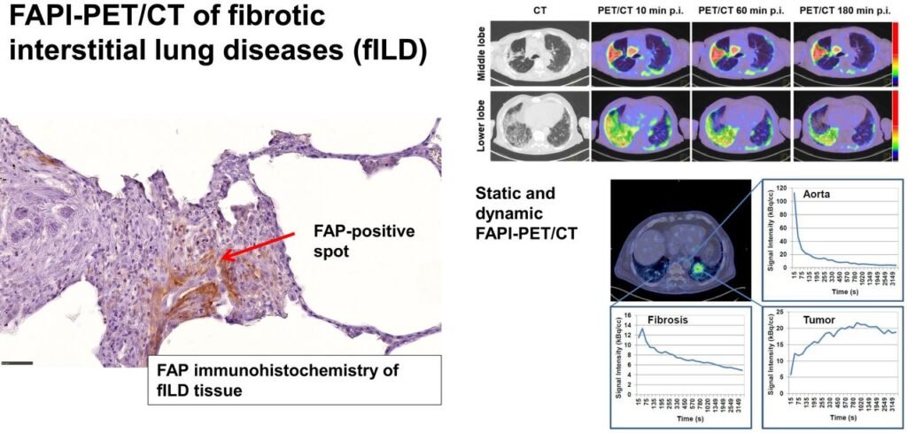 AI Predicts Lung Cancer Immunotherapy Side Effects