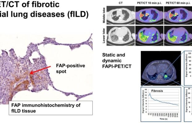 AI Predicts Lung Cancer Immunotherapy Side Effects