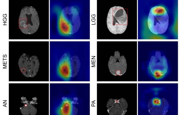 AI Models Show Promise in Identifying Brain Tumors