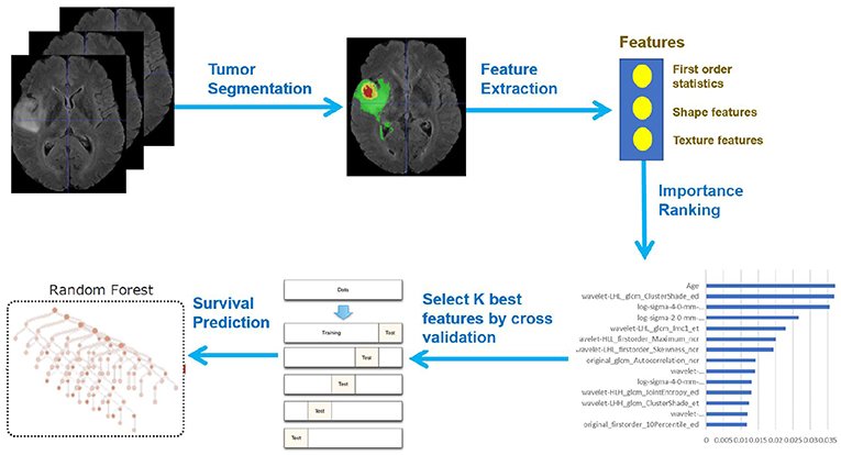 AI Model Offers Non Invasive Detection of Brain Cancer Spread