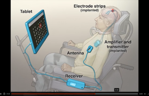 NHStoTestBrainImplantforTreatingNeurologicalDisorders Yesil Science NHS to Test Brain Implant for Treating Neurological Disorders