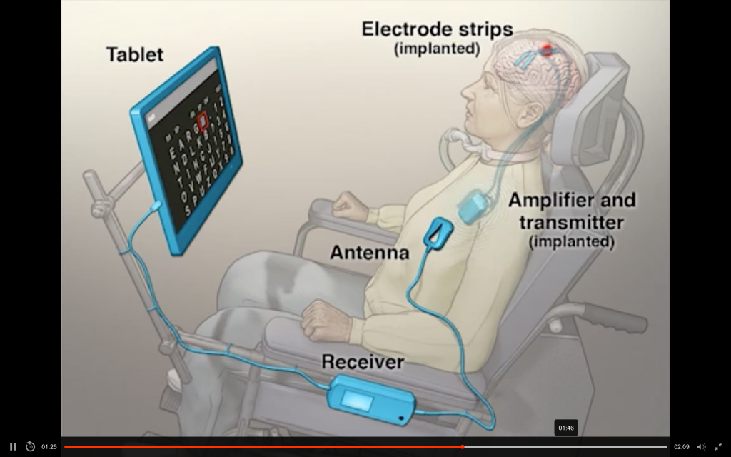 NHS to Test Brain Implant for Treating Neurological Disorders