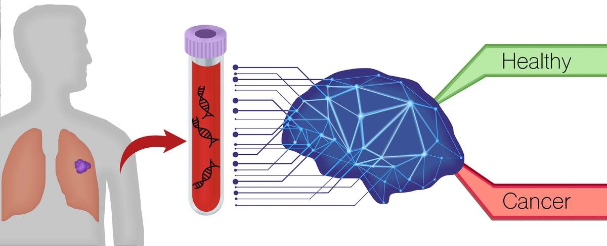 New AI Model Predicts Cancer Immunotherapy Success Using Blood Tests