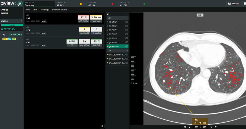 Coreline Soft Secures AI Imaging Contracts with NHS and Boehringer Ingelheim