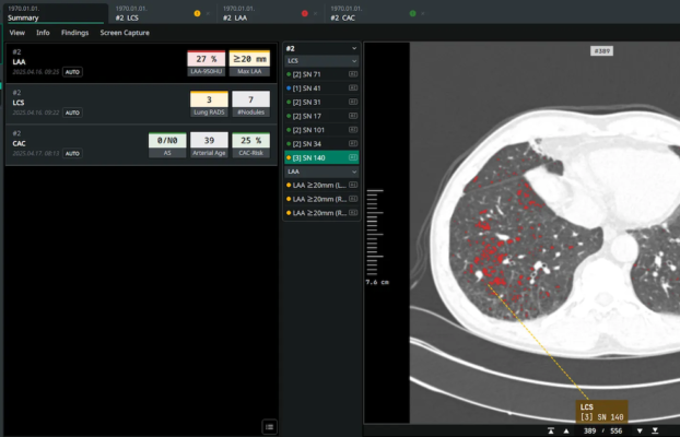 Coreline Soft Secures AI Imaging Contracts with NHS and Boehringer Ingelheim