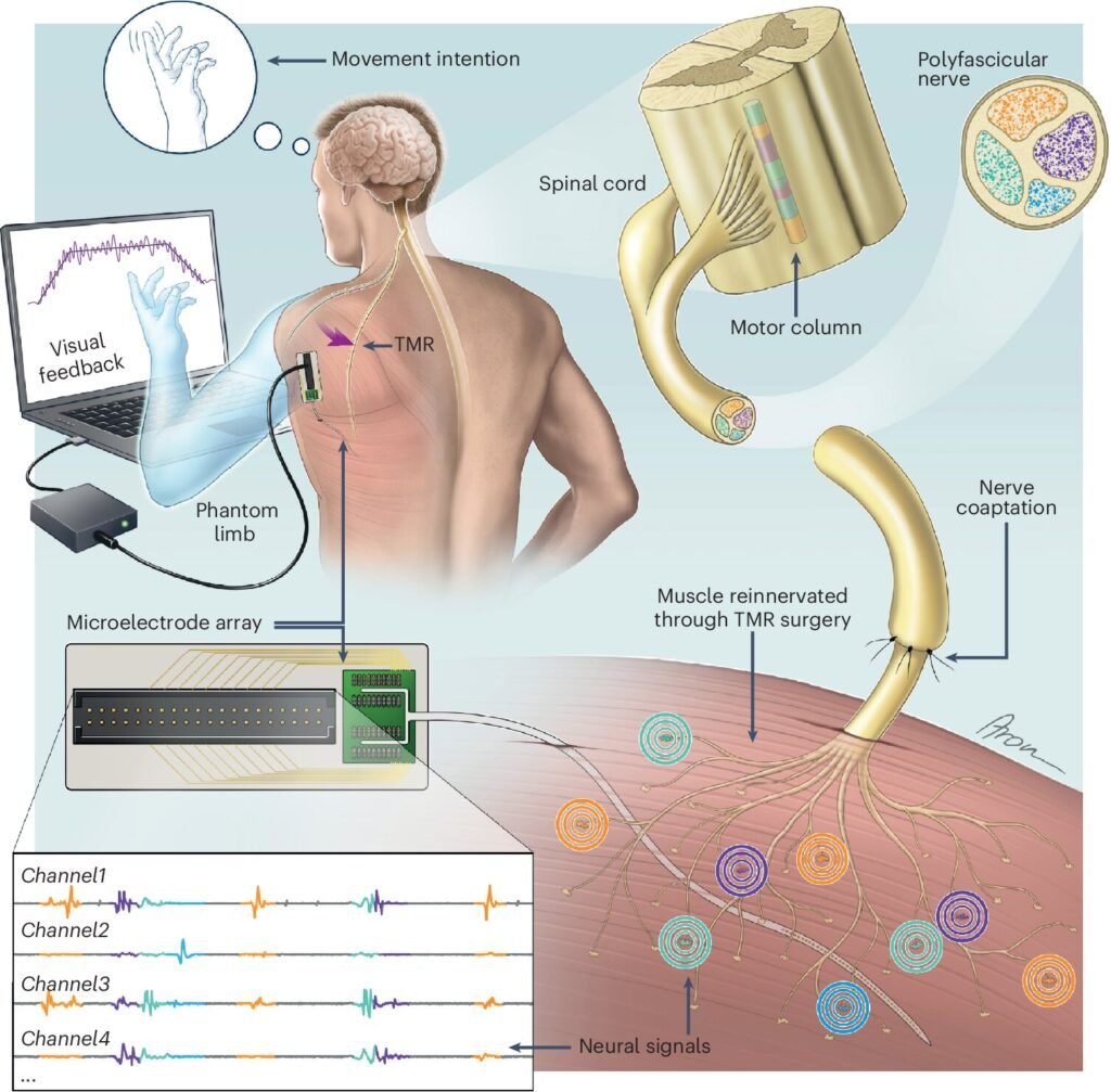 Innovative Approach to Control Bionic Prostheses Using Nerve Signals